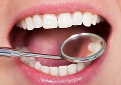Teeth examined with dental mirror
