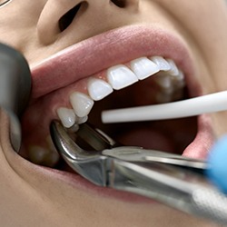 dentist doing tooth extraction