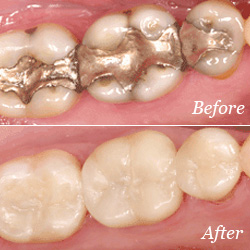dental fillings benbrook