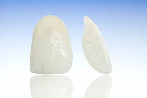 thin white porcelain veneer shells