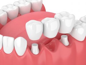 Dental crowns fitting over natural teeth