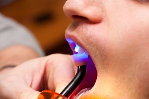 dental bonding being hardened under light