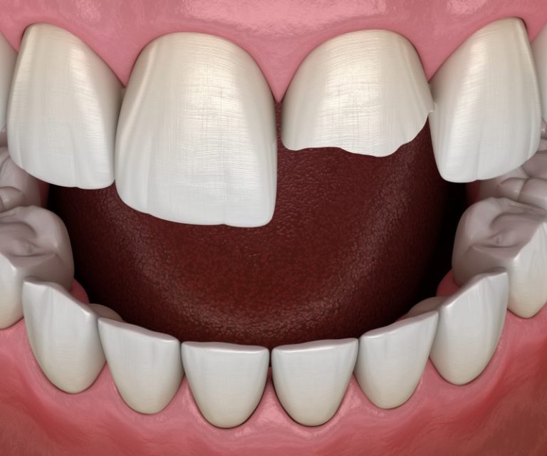 Why Do I Need a Dental Crown on Hulen for My Broken Tooth? Why Do I Need a Dental Crown on Hulen for My Broken Tooth?